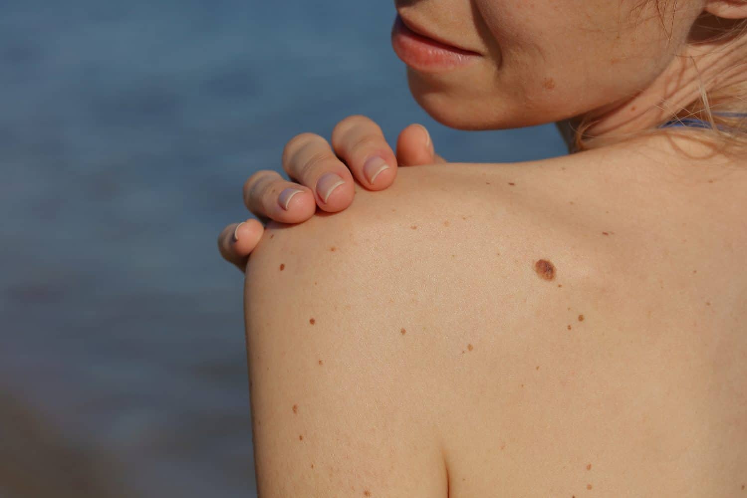 Jeseň je ideálny čas na kontrolu znamienok: Prevencia môže zachrániť život