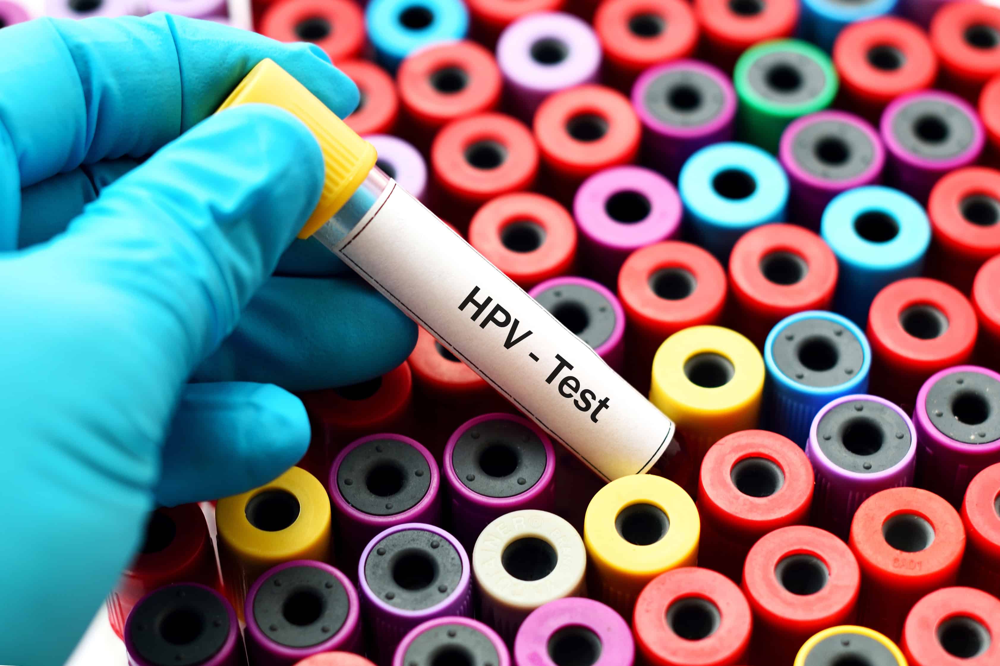 Košický kraj bojuje s nízkou prevenciou HPV: Účasť na očkovaní aj skríningu stále zaostáva